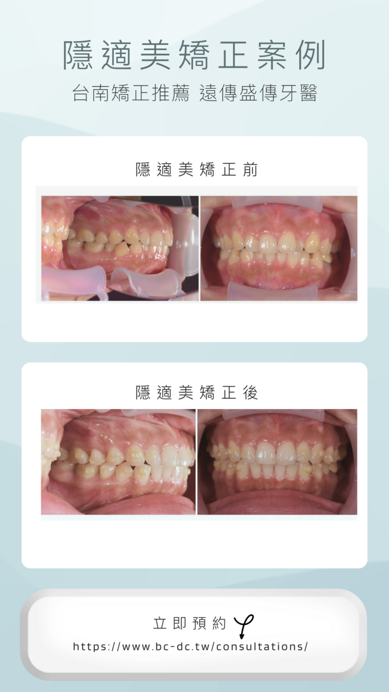 Grey-White-Modern-Teeth-Whitening-Before-After-Photo-Instagram-Story-1