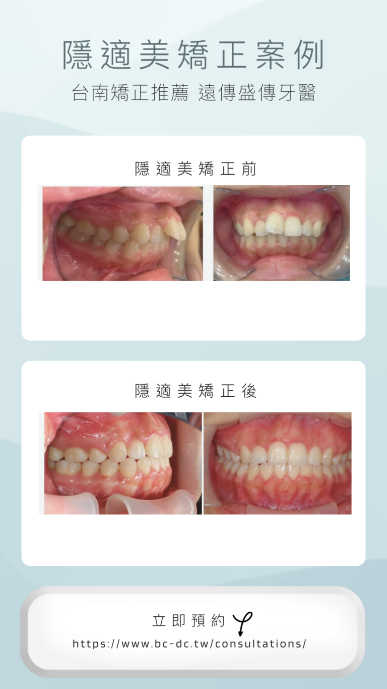 Grey-White-Modern-Teeth-Whitening-Before-After-Photo-Instagram-Story-2