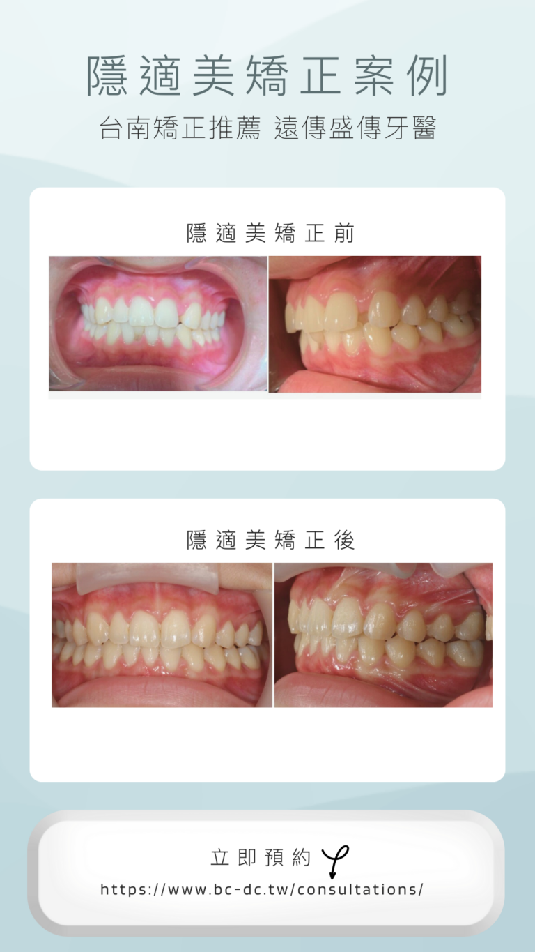 Grey-White-Modern-Teeth-Whitening-Before-After-Photo-Instagram-Story-3