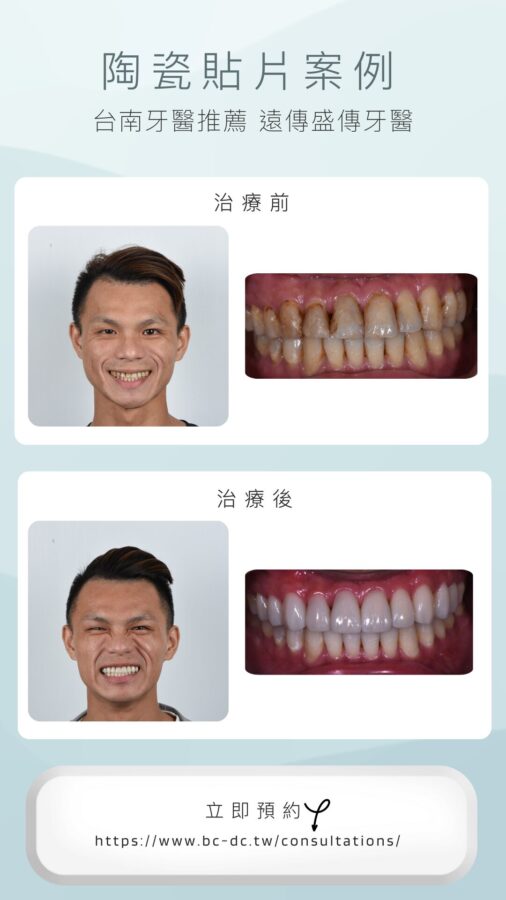 grey white modern teeth whitening before after photo instagram story 4 e1709613485774